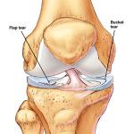 meniscus.jpg